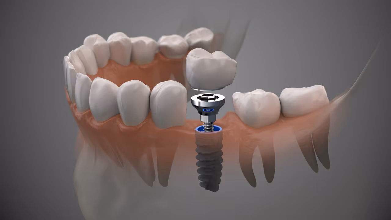 Is Pain After Dental Implants Normal or A Sign of Danger