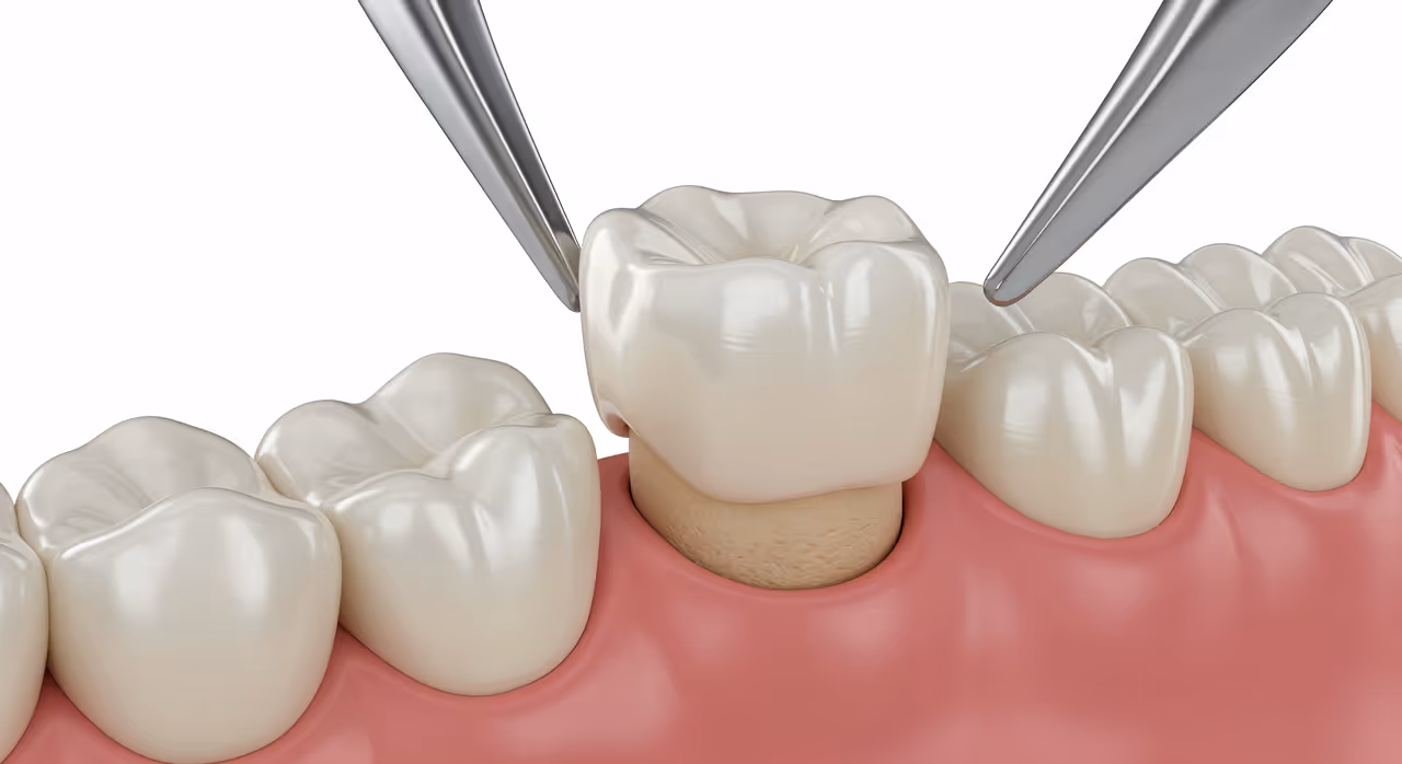 Everything You Need To Know About Dental Crowns