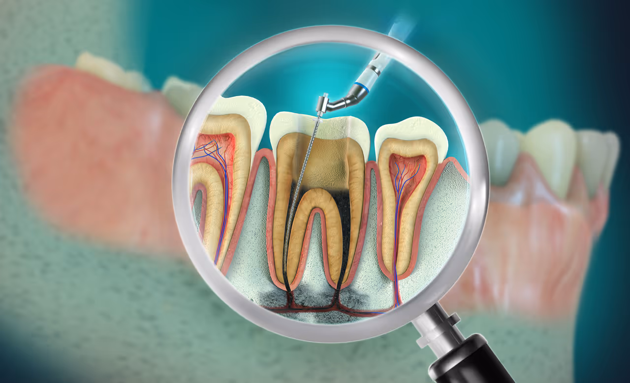 Understanding Endodontic Treatments: How Long Do Root Canals Last?
