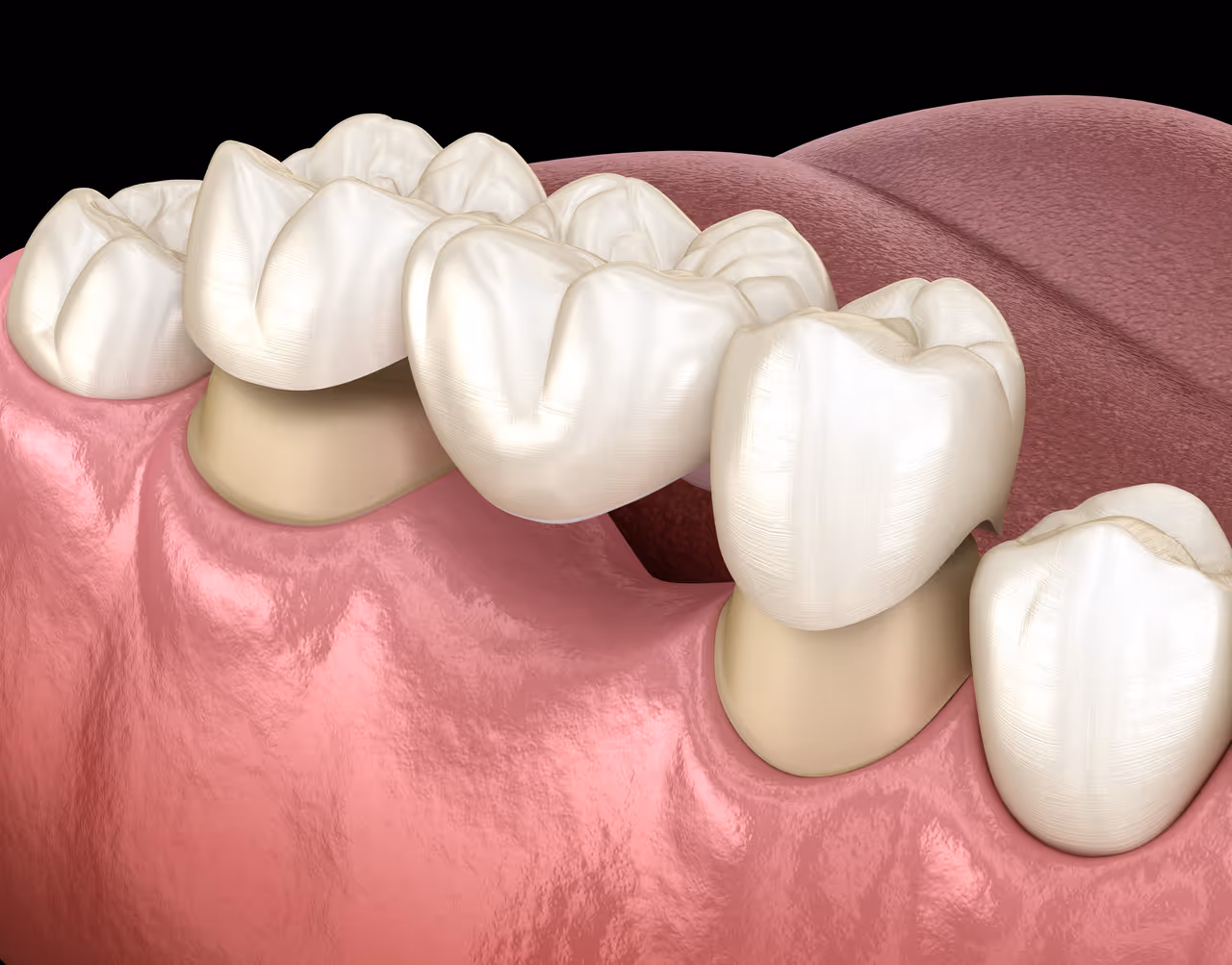Why Dental Bridges Are a Smart Choice for a Complete Smile